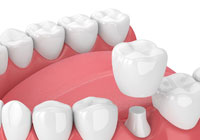 フルジルコニアクラウン