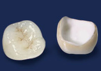 ジルコニアセラミッククラウン