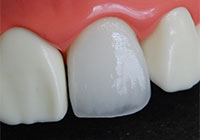 フルジルコニアクラウン