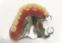 コバルトクロム床義歯